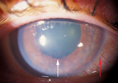 Ch 9. Glaucoma Emergency Acute angle closure glaucoma. A